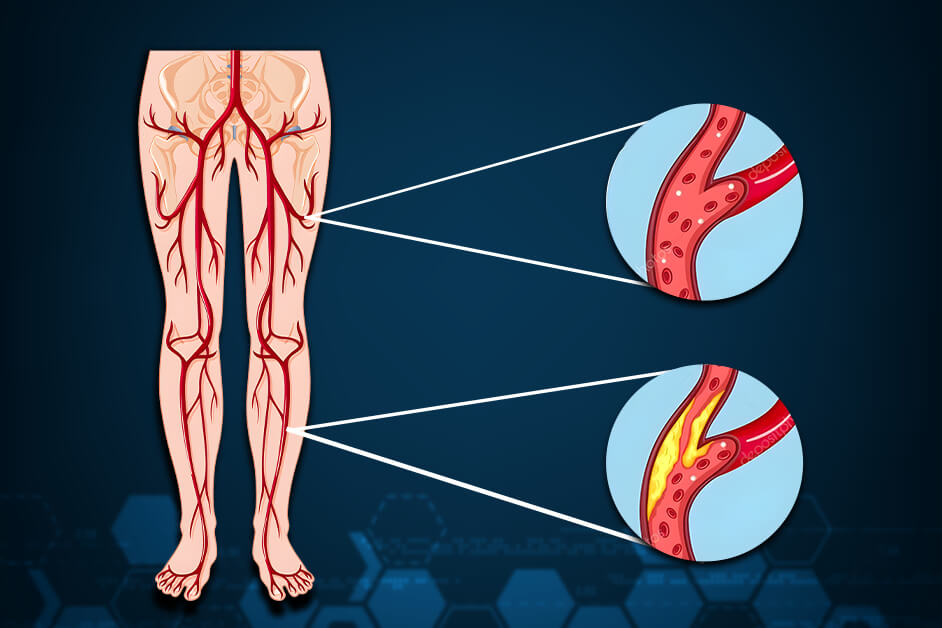 Gangrene Treatment In Hyderabad